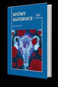 Myómy maternice - Redecha Mikuláš 1