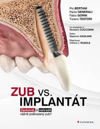 Zub vs. implantát - Pio Bertani, Paolo Generali, Fabio Gorni, Tiziano Testori 1
